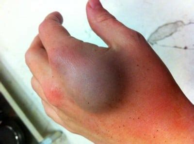 Feb 18, 2019 · as per your description, it indicates a broken finger. Broken Knuckle | Med Health Daily