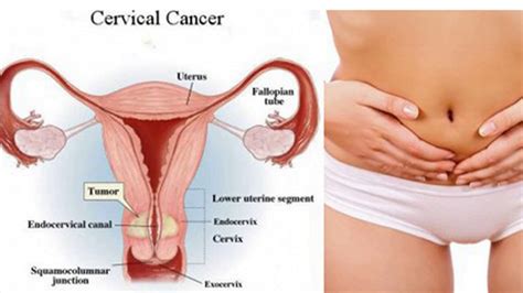 Although some patients don't experience any symptoms until cervical cancer has advanced, it may be possible to notice signs at an early stage. Pelvic Pain Is Warning Sign Of Cervical Cancer- Cervical ...