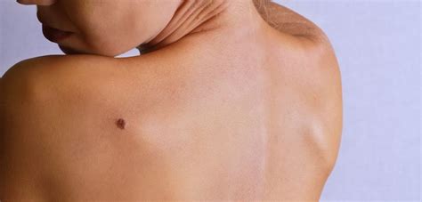Mediziner bezeichnen ihn als malignes melanom. Hautkrebs behandeln: Wie heilbar ist Hautkrebs?