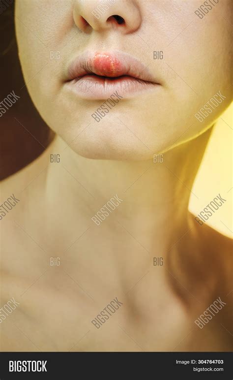 Gfeller cf., wanser r., mahalingam h., moore dj., wang x., lin cb., shanga g., grove g., rawlings av. Herpes On Upper Lip Image & Photo (Free Trial) | Bigstock