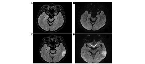 Cerebral venous thrombosis (cvt) is a rare but emergent cause of headache. Broca's aphasia due to cerebral venous sinus thrombosis ...