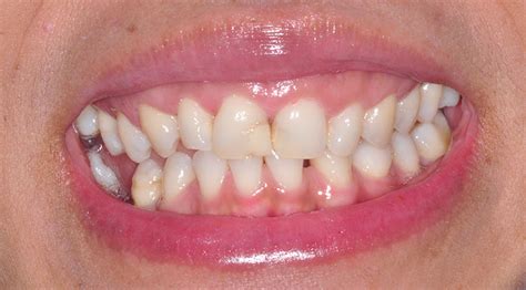 Invisalign dentist, dental implants, whitening, nhs appointments. Smile Gallery - Eledent - Dentist in Sutton Eledent ...