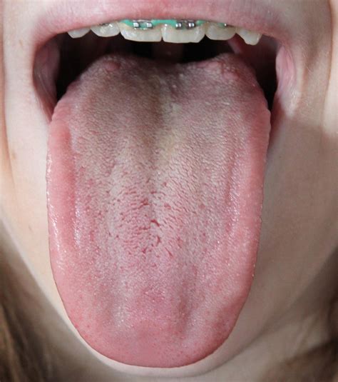 Introduction to Tongue Assessment for the Western Herbalist