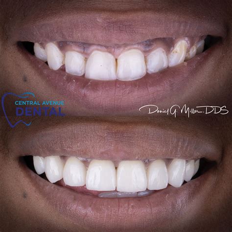 But first, consider the cost for just a single porcelain dental veneer that can run well over $500. Veneers in Charlotte NC - Central Avenue Dental