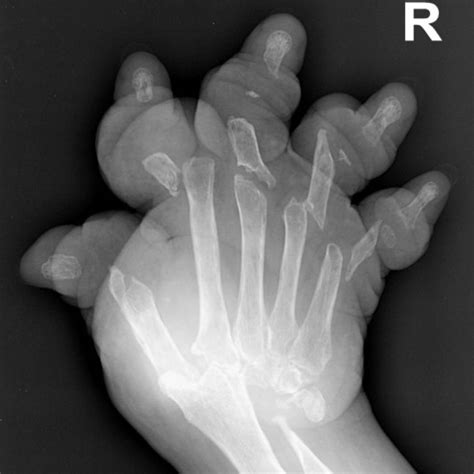 And webs or strictures in the distal hypopharynx or proximal esophagus.40,41 the. Plummer-Vinson Syndrome with Mutilans Rheumatoid Arthritis ...