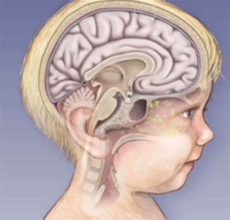 We did not find results for: Cara alami sembuhkan meningitis pada anak ~ Cara Mengobati ...