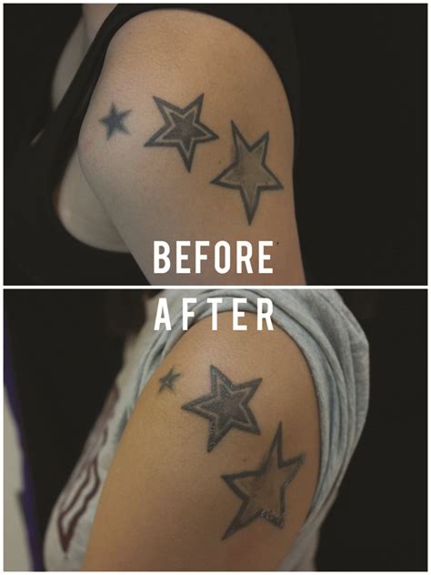 How painful is laser tattoo removal? To rub out the stars: Quick, cheap, but not pain-free ...