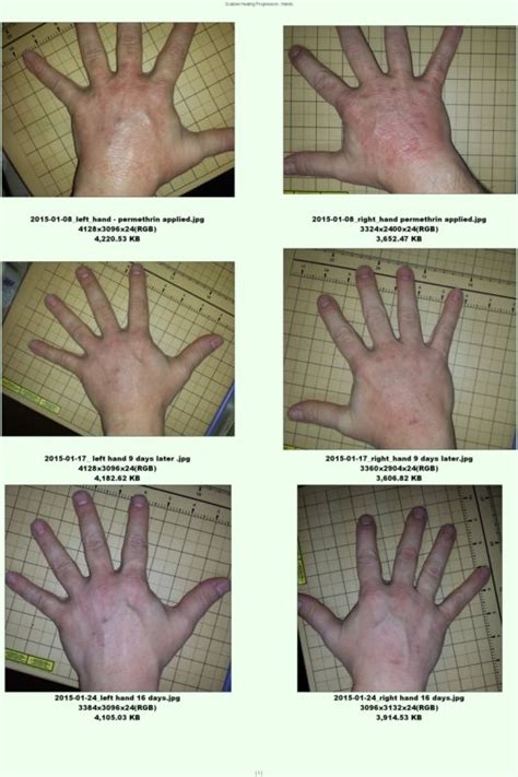 We did not find results for: How do you know when it has gone?? | Page 2 | Scabies ...