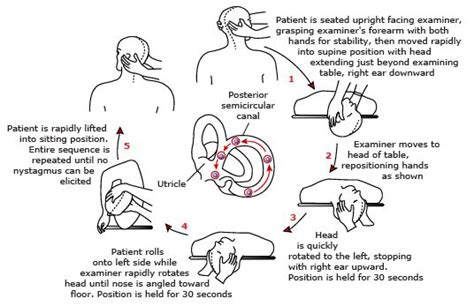 The epley maneuver or repositioning maneuver is a maneuver used by medical professionals to treat one common cause of vertigo, benign paroxysmal positional vertigo (bppv) of the posterior or anterior canals of the ear. EPLEY MANOEUVRE PDF