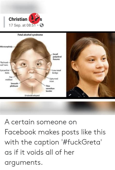 Epicanthic folds are sometimes one of the features of certain medical conditions, especially congenital anomalies. Flat Nasal Bridge And Epicanthal Folds / Respiratory Heent ...