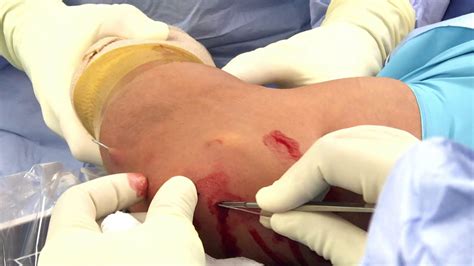Olecranon Stress Fracture Repair - YouTube
