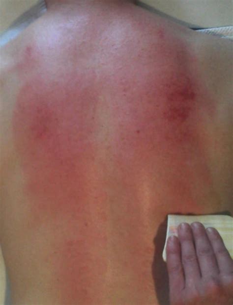 Plug informs me that gua sha and. Gua Sha (Scraping)