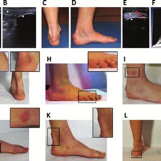 Wrist bilateral piezogenic papules of the heel. Foot ''hot spots'' in figure skaters. (A) Ultrasound image ...