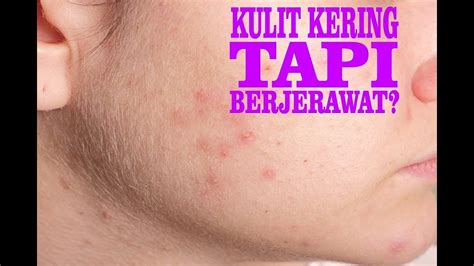 Warga asing sesakkan pengangkutan awam. 3 Langkah Mudah Mengatasi Jerawat Pada Kulit Kering - YouTube