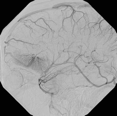 Weiteres empfehlenswertes fachwissen leitfaden zu den. Thrombose eines venösen Angioms mit sekundärem Stauungsinfarkt | SpringerLink