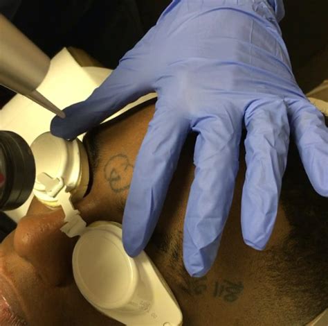 We did not find results for: Soulja Boy gets laser treatment on his face to remove his ...