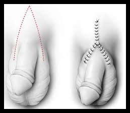 Após a faloplastia, em 1999, o procedimento para a metoidioplastia foi desenvolvido pelos médicos para a transição cirúrgica de mulher para homem. Dr. Alberto Lajo Rivera - Faloplástia