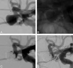 Coil Occlusion of Wide-Neck Bifurcation Aneurysms Assisted by a Novel Intra- to Extra 