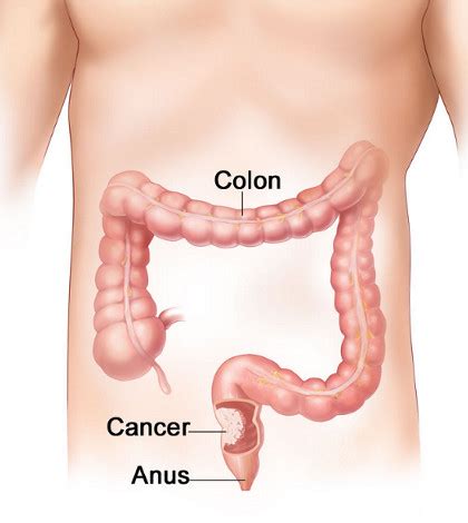 Every person over 50 should schedule a regular colonoscopy. Colorectal Cancer: Causes, Symptoms, and Treatment ...
