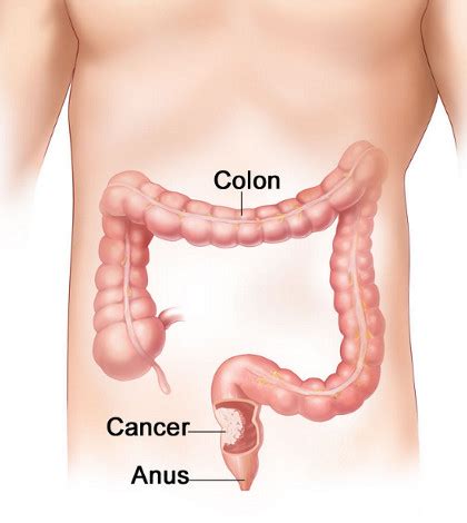 The lower and bigger half of the bowels in which water is removed from solid waste 2. Colorectal Cancer: Causes, Symptoms, and Treatment ...