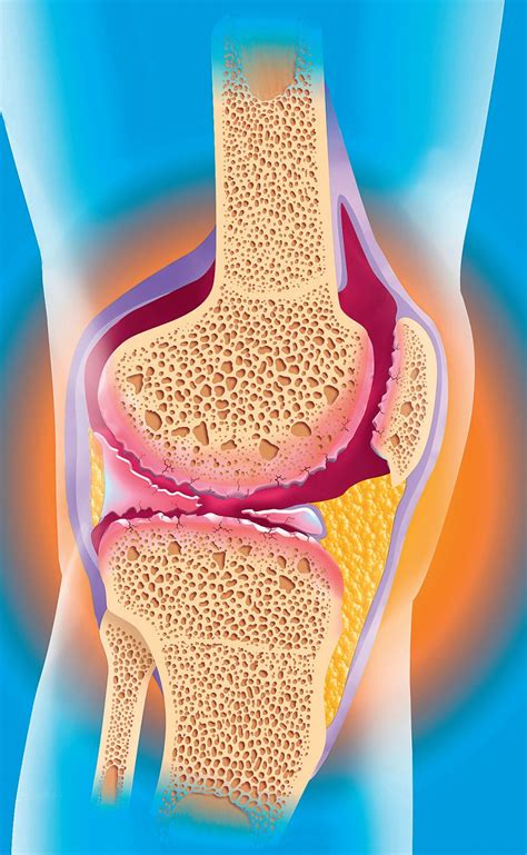 Ihr hausarzt eine rheumatologische mitbetreuung anstreben, denn die richtige diagnose ist gerade im frühstadium von bedeutung. Knietotalendoprothese: Wann ist der Ersatz angebracht?