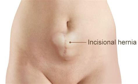 Facts everybody should know about a hernia Incisional Hernia - Pictures, Repair, Complications ...