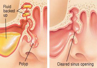 Normal function usually returns within one to two months. Nasal Polyps Guide: Causes, Symptoms and Treatment Options