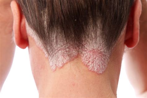 Psoriasis, which can involve the skin, nails and joints, is a chronic, painful, disfiguring and disabling noncommunicable disease (ncd) for which there is no cure. Psoríase do Couro Cabeludo - Dermatologista Porto Alegre ...