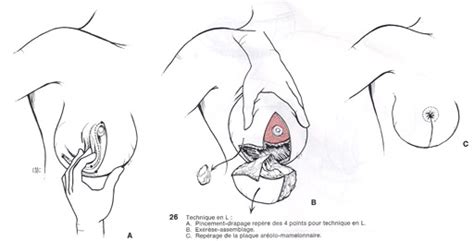 Les volumes dame nature a décidé comme ça, de façon tout à fait arbitraire, de nous doter d'une paire de seins qui ne ressemblent à aucune autre. Diminution mammaire, diminution des seins, réduction mammaire, diminution mammaire cannes ...