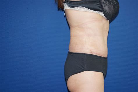 Elle permet de corriger les imperfections au niveau du ventre, qu'il s'agisse. Photo avant-apres abdominoplastie, lifting du ventre