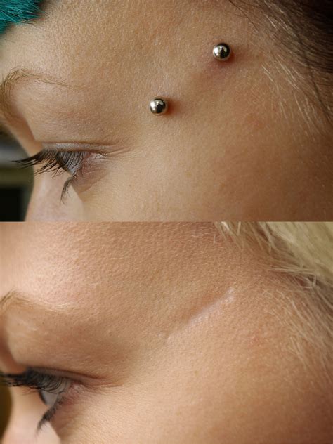 That's because dermals don't have a separate entry and exit point for jewelry, unlike traditional piercings. Dermal Piercing: Pictures, Procedure, Aftercare, and Risks ...
