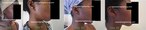 Meladerm before and after pictures | meladerm before and after pictures inexpensive review. White Chic Glutathiones | Lighten skin, Good skin, Skin cream