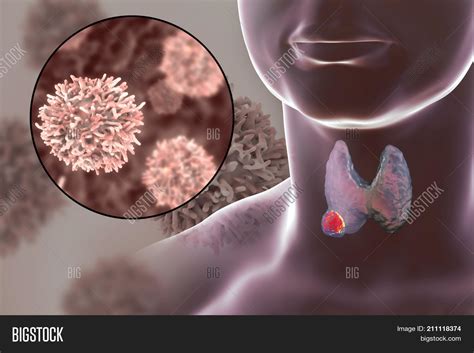 Thyroid cancer is cancer that develops from the tissues of the thyroid gland. Thyroid Cancer. 3D Image & Photo (Free Trial) | Bigstock