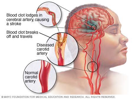 Doa mencegah merawat angin ahmar rihul ahmar penyakit stroke lumpuh. Doa dan Petua Elak Terkena Angin Ahmar/Stroke | Islam