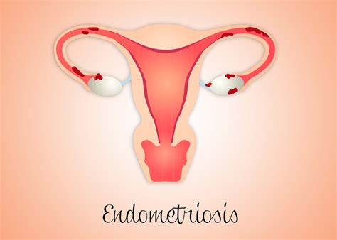 An early diagnosis, a multidisciplinary the main complication of endometriosis is impaired fertility. Types of Endometriosis | Staging of Endometriosis ...
