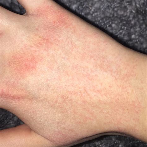 Was ist ein ekzem und wie sieht diese erkrankung aus? Kleine rote Pünktchen auf der Hand? (Gesundheit, Allergie ...