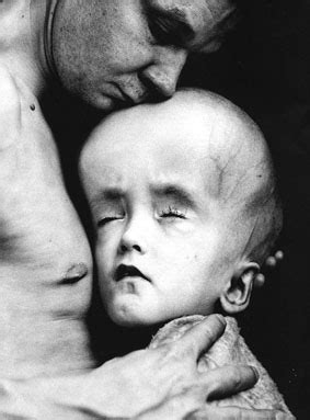 Les malformations, telles que définies par les normes internationales. Janvier 2006, à l'hôpital de Gomel, (photo Tom Stoddart ...