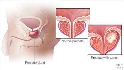 Pendant longtemps, le dépistage et diagnostic du cancer de la prostate se faisaient essentiellement par le toucher rectal. Movember : la moustache en novembre pour le cancer de la ...