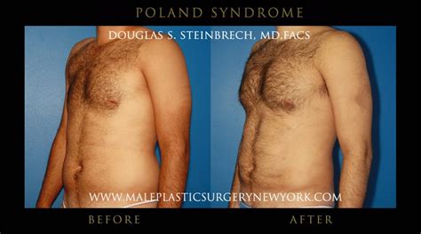 The first signs are visually noticeable during the period of. Poland Syndrome Surgery Before And After Images | Poland ...