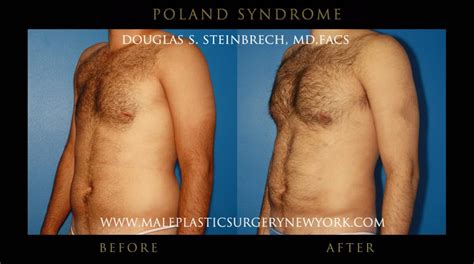 Poland syndrome is a rare, congenital condition characterized by a sunken or underdeveloped chest and hand abnormalities. Poland Syndrome Surgery Before And After Images | Poland ...