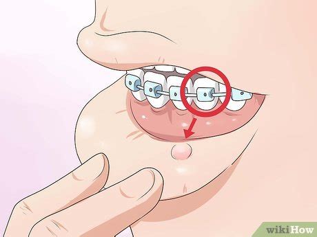 Then apply it to the bruise and allow the tea bag to sit on the bruise for a few minutes before removing. วิธีการ ทำให้การจัดฟันเจ็บน้อยลง (พร้อมรูปภาพ) - wikiHow