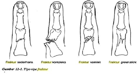 Tidak jelas, misalnya nyeri kepala, pusing, depresi, penglihatan kabur dan rasa baal. Health and Beauty Blog: KONSEP FRAKTUR