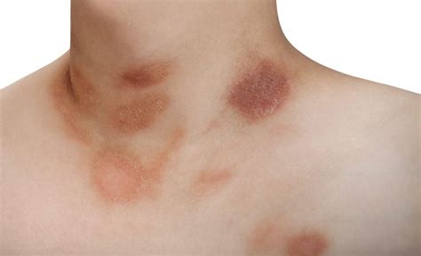 Papulosquamous eruption of pityriasis rosea. What Is Pityriasis Rosea? - Symptoms and Treatment ...