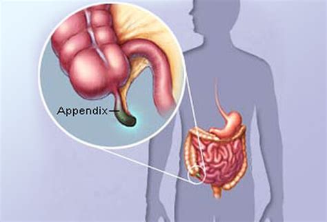 When appendices might be necessary. Appendicitis definition and facts | Matthew Johnson MD, FACS