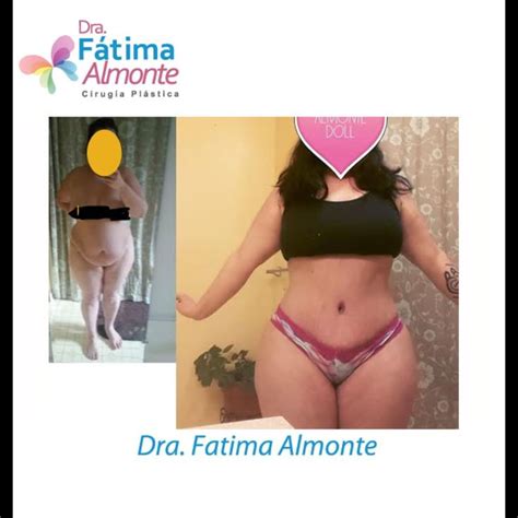 While these two procedures can be completed at the same time, we usually recommend but, if you decide on having these procedures at the same time consider sleeping on your sides or place pillows under your back and thighs to. A determined doll happy with her results! Tummy tuck lipo ...