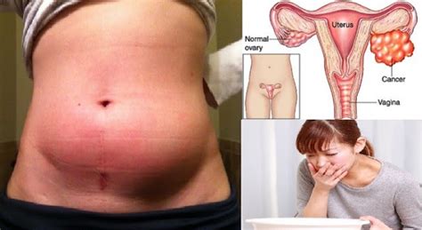 Rates of lung cancer differ among females and males, but symptoms and risk factors are the same. Ovarian cancer - Global Women Connected