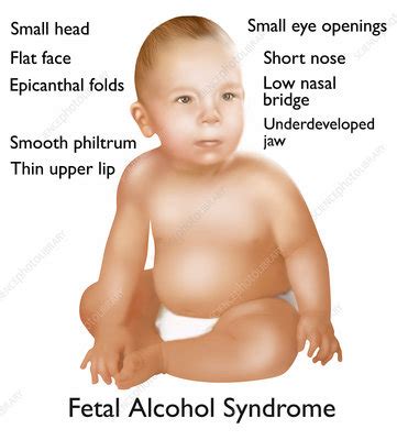 Flat nasal bridge and epicanthal folds : Flat Nasal Bridge And Epicanthal Folds : Big Blueberry ...