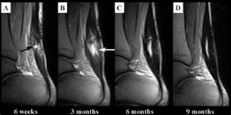 Achilles tendon pathologies include rupture and tendonitis. Figure 3 from Magnetic Resonance Imaging of Achilles ...