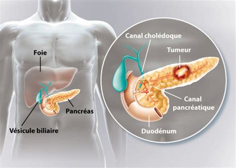 Comment savoir si j'ai un cancer du pancréas ? | Clinique des Cèdres