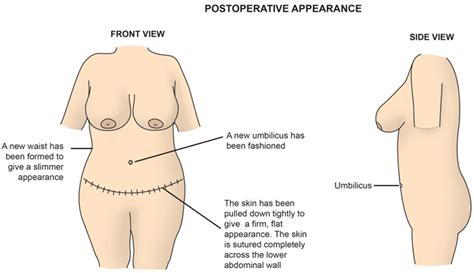 Hernia repair surgery can also be very painful, depending whether it is abdominal or inguinal hernia. Divarication